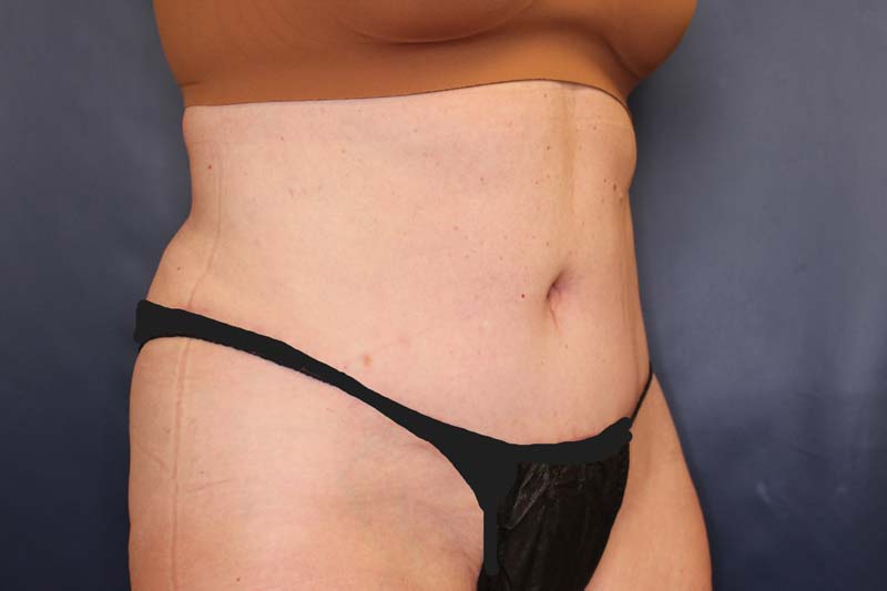 Tummy Tuck Before & After Image
