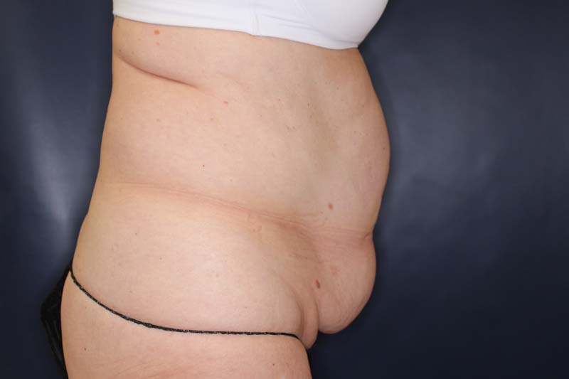Tummy Tuck Before & After Image