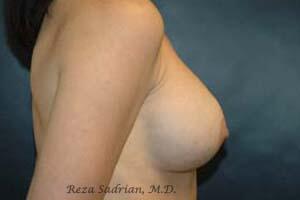 Breast Asymmetry Correction Before & After Image