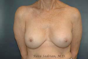 Breast Asymmetry Correction Before & After Image