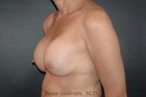 Breast Asymmetry Correction Before & After Image