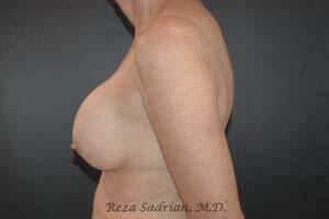 Breast Asymmetry Correction Before & After Image