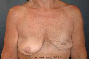 Breast Asymmetry Correction Before & After Image