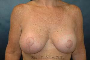 Breast Asymmetry Correction Before & After Image