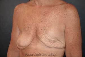 Breast Asymmetry Correction Before & After Image