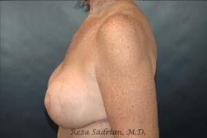 Breast Asymmetry Correction Before & After Image