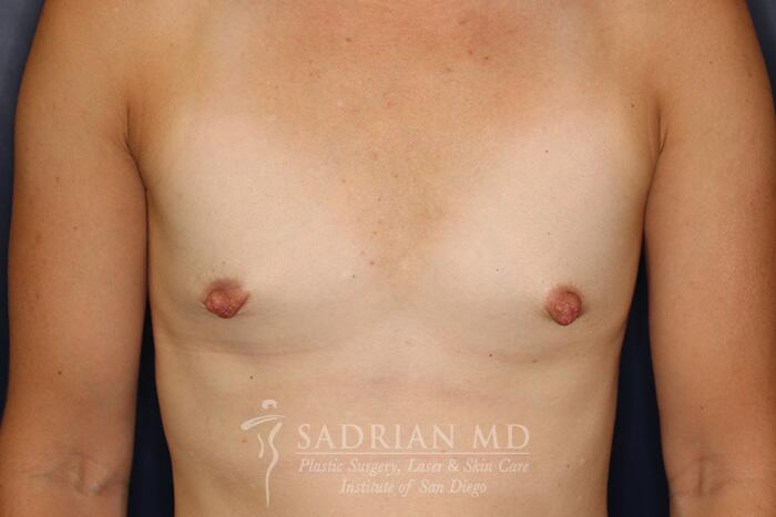 Breast Augmentation Before & After Image