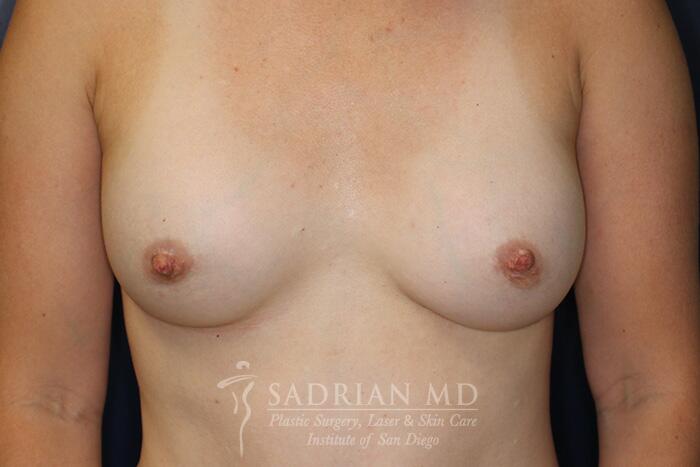 Breast Augmentation Before & After Image