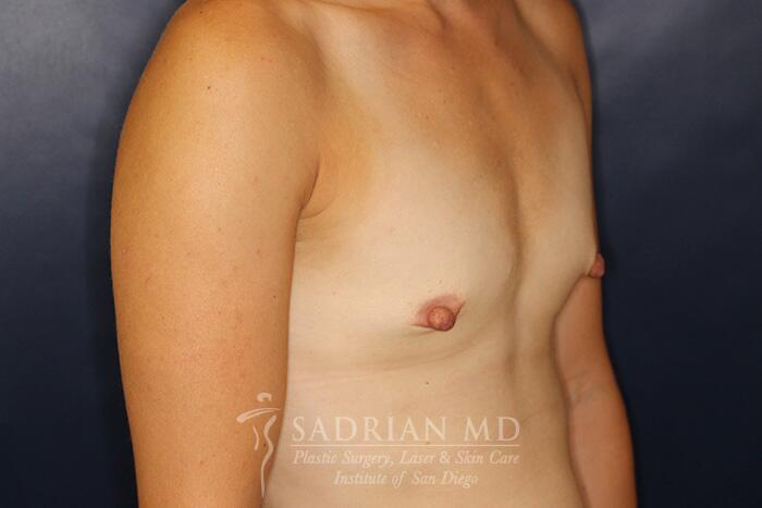 Breast Augmentation Before & After Image