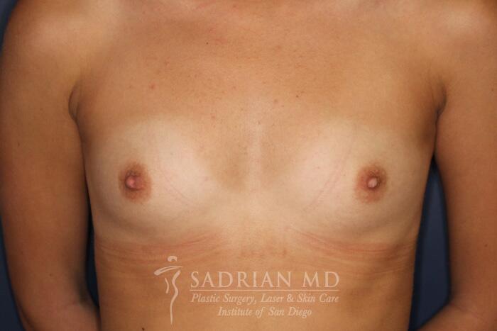 Breast Augmentation Before & After Image