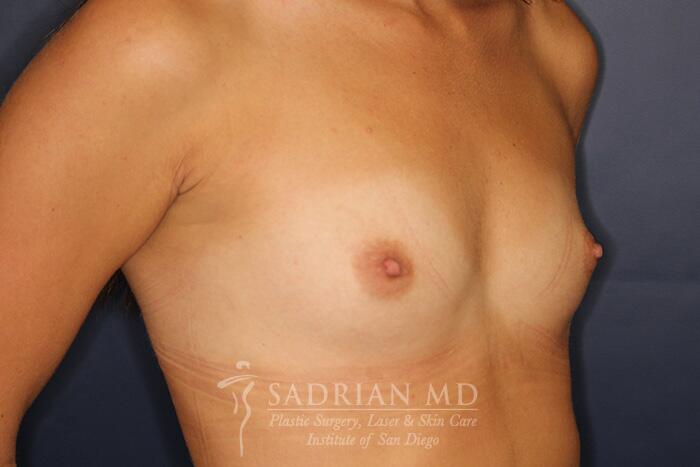 Breast Augmentation Before & After Image