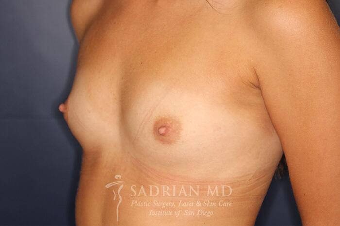 Breast Augmentation Before & After Image