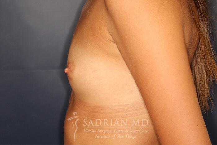 Breast Augmentation Before & After Image