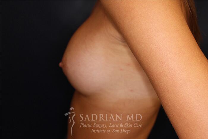 Breast Augmentation Before & After Image