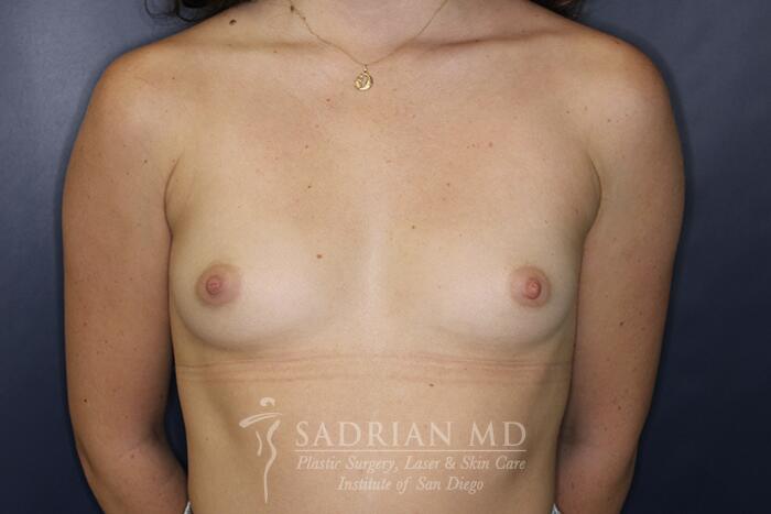 Breast Augmentation Before & After Image