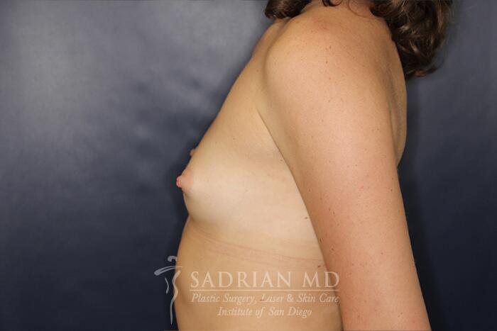 Breast Augmentation Before & After Image