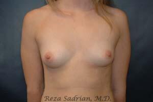 Breast Augmentation Before & After Image