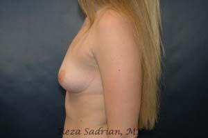 Breast Augmentation Before & After Image