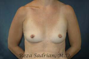 Breast Augmentation Before & After Image