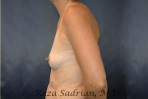 Breast Augmentation Before & After Image