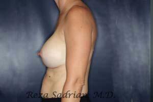 Breast Augmentation Before & After Image