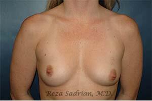 Breast Augmentation Before & After Image