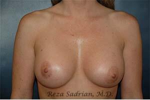 Breast Augmentation Before & After Image