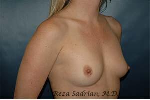 Breast Augmentation Before & After Image