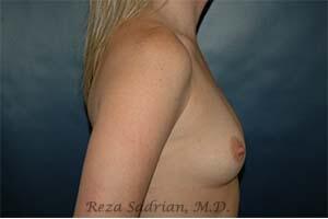 Breast Augmentation Before & After Image