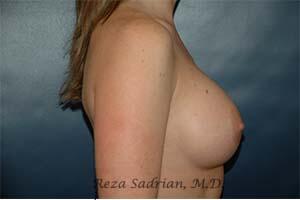 Breast Augmentation Before & After Image