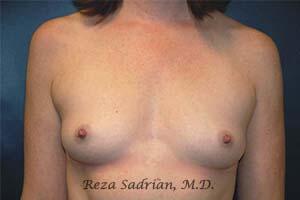 Breast Augmentation Before & After Image