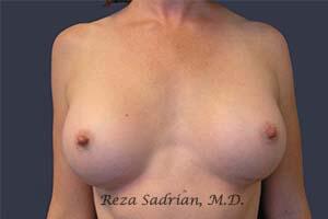 Breast Augmentation Before & After Image