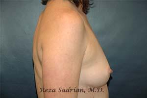 Breast Augmentation Before & After Image