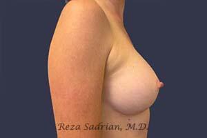 Breast Augmentation Before & After Image