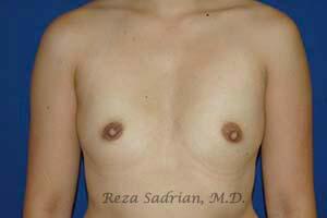 Breast Augmentation Before & After Image