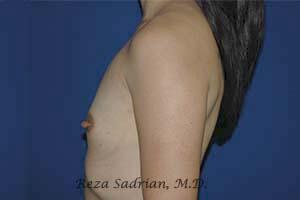 Breast Augmentation Before & After Image