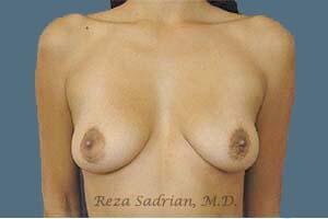 Breast Augmentation Before & After Image