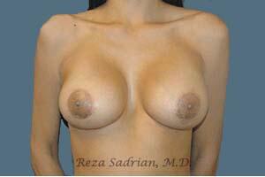 Breast Augmentation Before & After Image