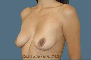 Breast Augmentation Before & After Image