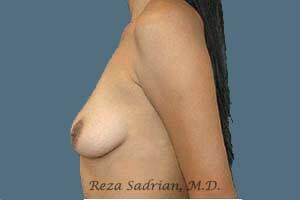 Breast Augmentation Before & After Image