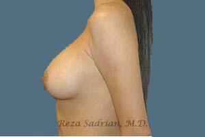 Breast Augmentation Before & After Image