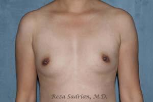 Breast Augmentation Before & After Image