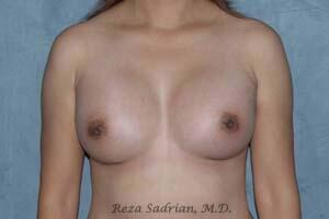 Breast Augmentation Before & After Image