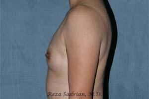 Breast Augmentation Before & After Image