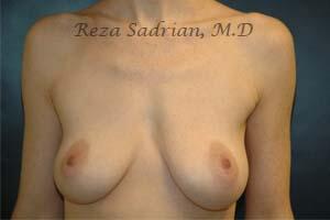 Breast Augmentation Before & After Image