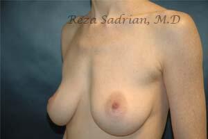 Breast Augmentation Before & After Image