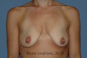 Breast Augmentation Before & After Image