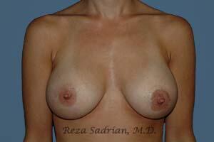 Breast Augmentation Before & After Image