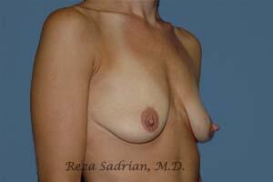 Breast Augmentation Before & After Image