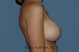 Breast Augmentation Before & After Image